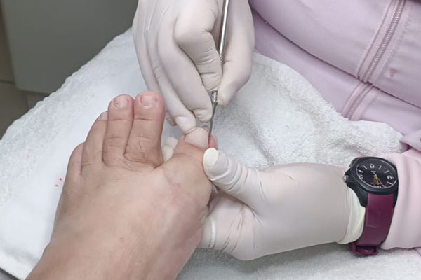 Podóloga cortando unha encravada em dedo de paciente Podóloga cortando unha encravada em dedo deo paciente